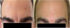 Acido ialuronico glabella