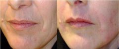 Acido ialuronico rughe biostimolazione