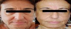 Rughe glabella nasogeniene