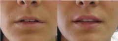 Aumento labbra con acido ialuronico