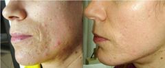Needling peeling Filler