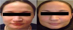 Peeling per acne