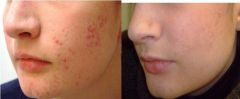 Peeling per acne
