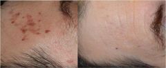 Peeling TCA crioterapia