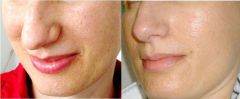 Peeling per Cicatrici acne melasma