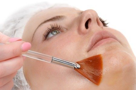 peeling chimico viso costo